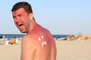 Ein Mann mit Sonnenbrand